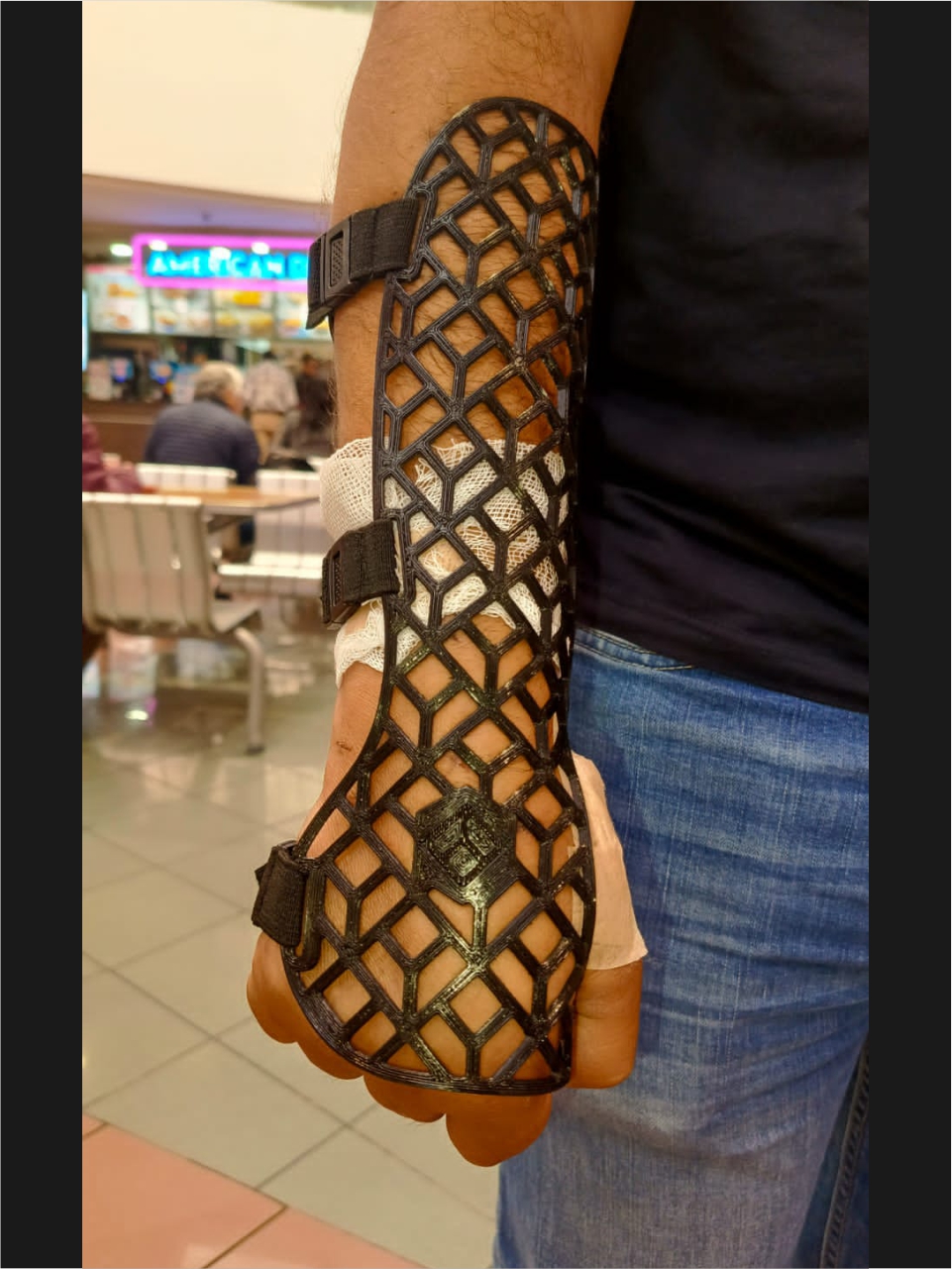 Postraumático: fractura de antebrazo por caída