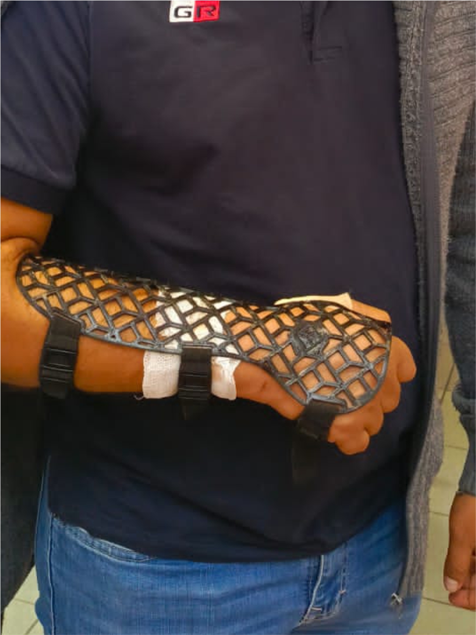 Postraumático: fractura de antebrazo por caída