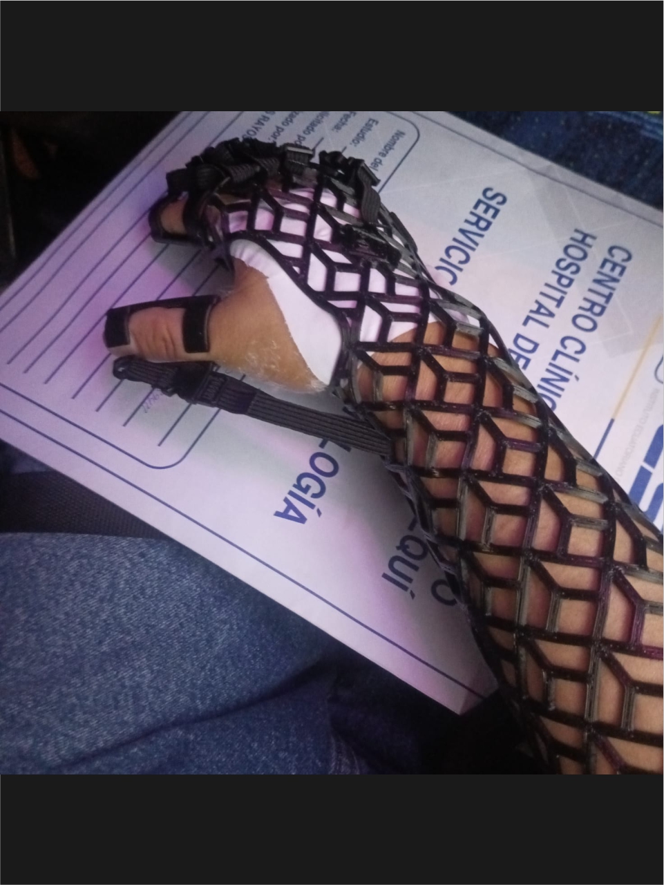 Férula radial adaptada para uso clínico y funcional