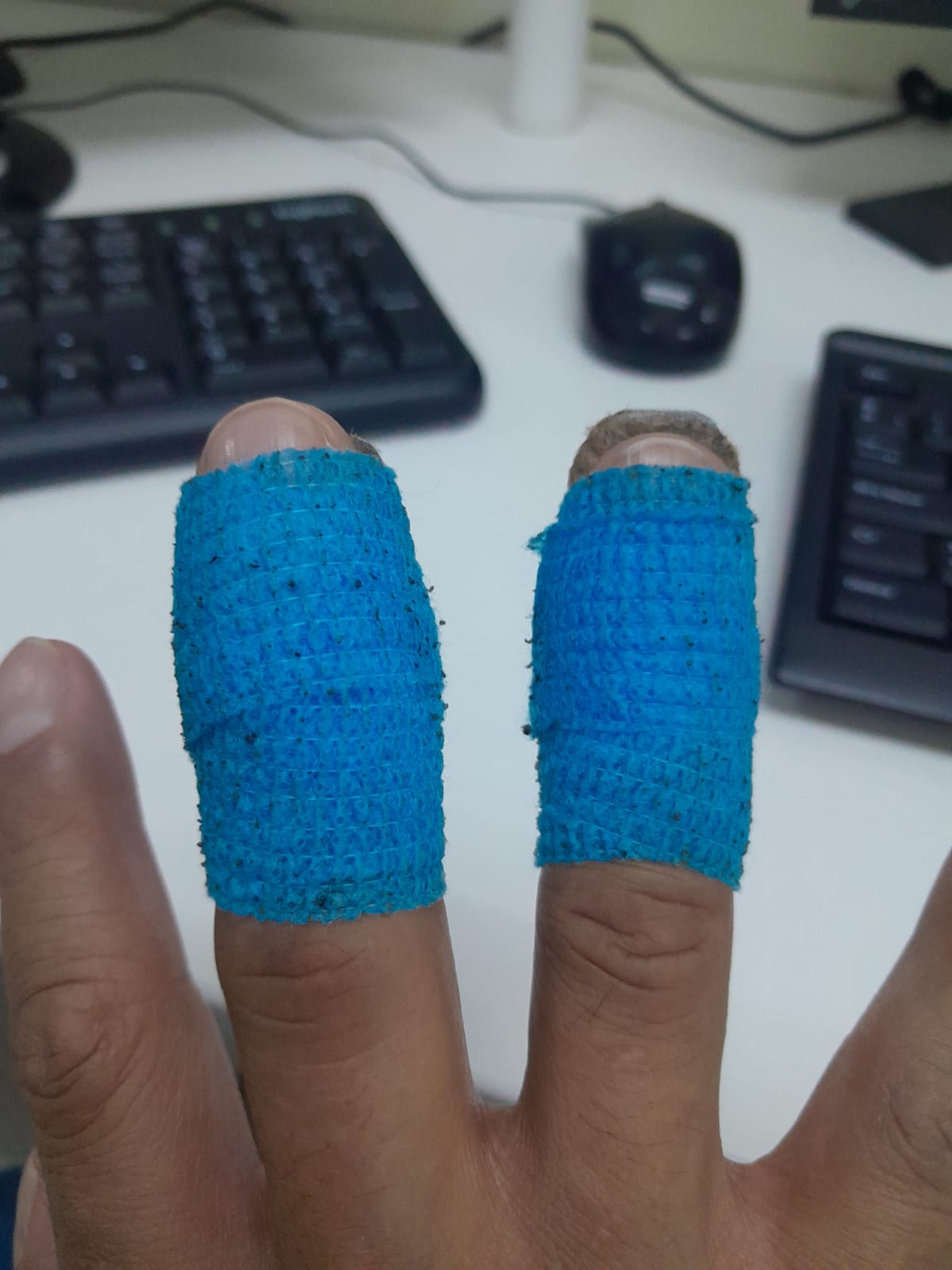 Lesión Mallet Finger en dedos medio y anular