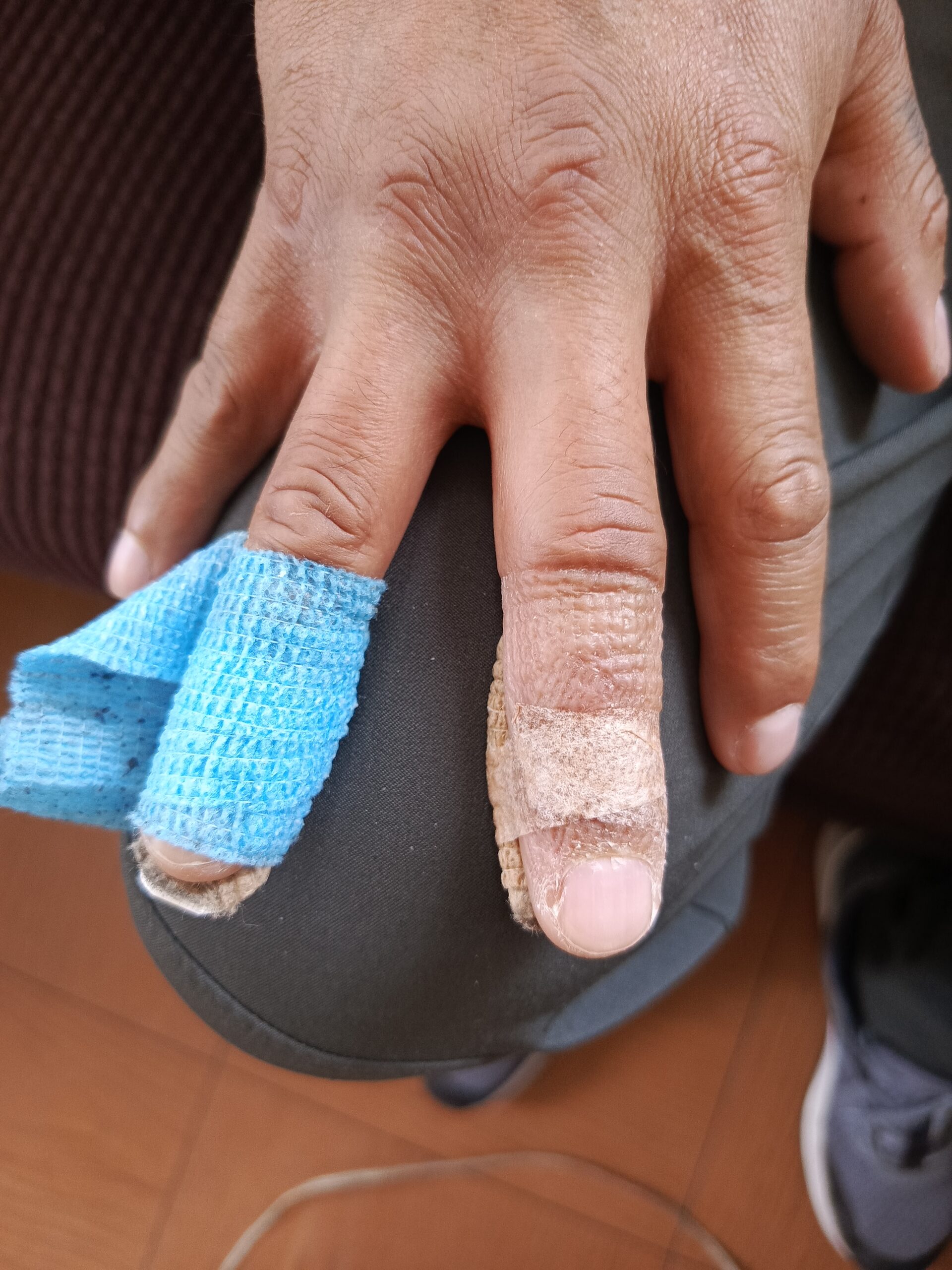 Lesión Mallet Finger en dedos medio y anular