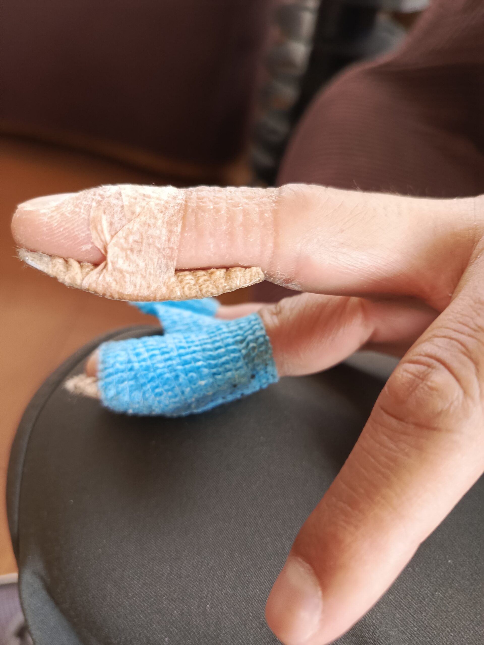 Lesión Mallet Finger en dedos medio y anular