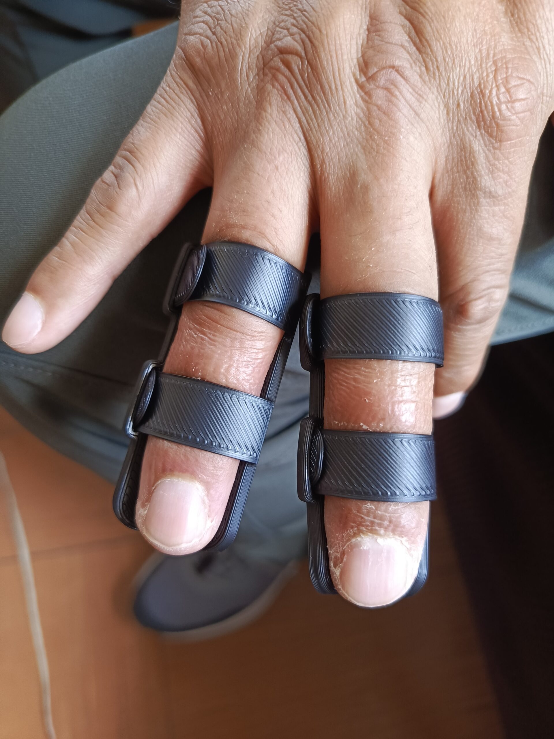 Lesión Mallet Finger en dedos medio y anular